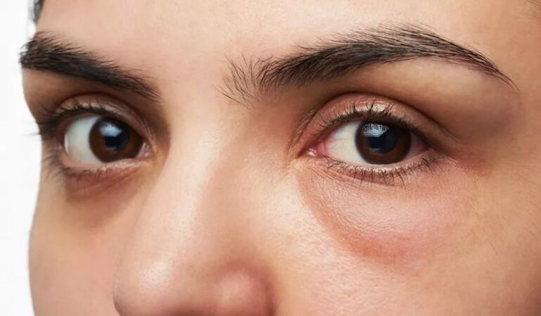 Taschen unter den Augen, Schwellung