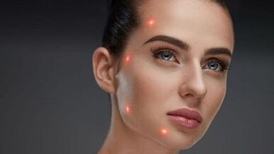 Was ist eine fraktionierte Hautverjüngung