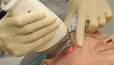 Wie eine fraktionierte Hautverjüngung durchgeführt wird