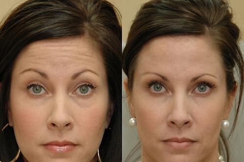 Botulinumtoxin-Injektionen sind für die Anwendung in allen Gesichtsbereichen geeignet
