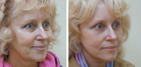 Frau vor und nach der Plasma-Gesichtshautverjüngung