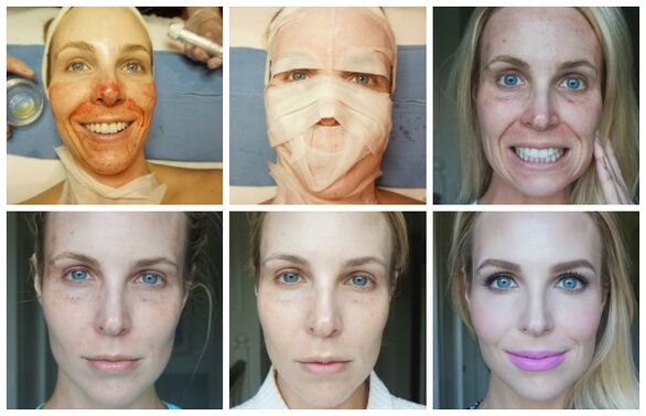 Heilungsstadien der Gesichtshaut nach erfolgreichem Plasma-Facelift